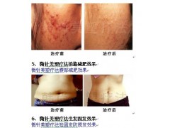 微针美容1图3